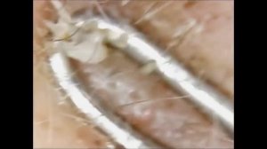 Выдавливание черных точек под микроскопом часть 3