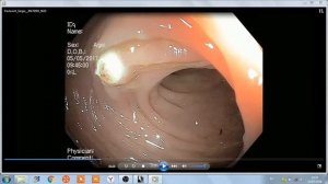 КОЛОНОСКОПИЯ