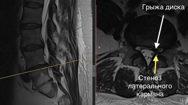 Лечение грыжи диска отзыв после эндоскопической операции смотреть онлайн