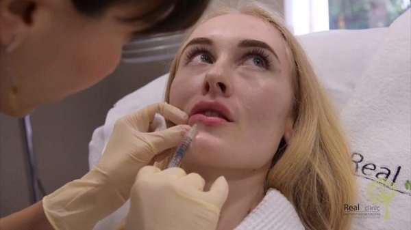 REAL CLINIC | Увеличение губ | Teosyal