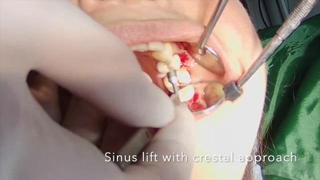 #25 implant + sinus lift without bone смотреть онлайн