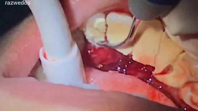 Удаление зубного камня.Следите за тем, как мы его удаляем смотреть онлайн