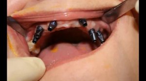 Имплантация при полном отсутствии зубов. Верхняя челюсть. Установка 6 ICX-templant.