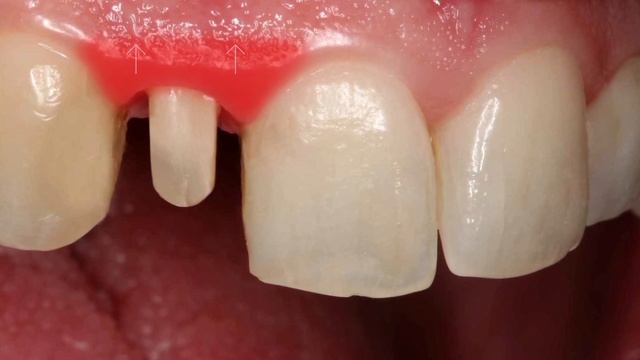 Для Чего Нужны Временные Коронки? смотреть онлайн