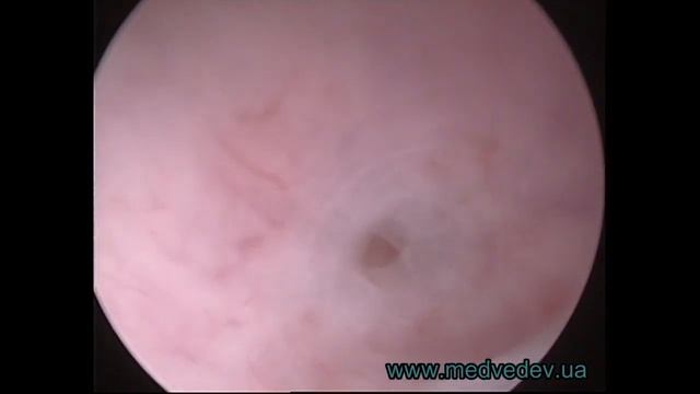 Медведев восстановление устья трубы смотреть онлайн