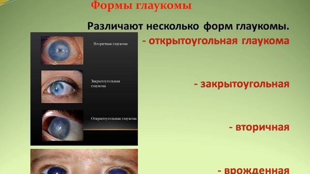 Тема:Глаукома смотреть онлайн