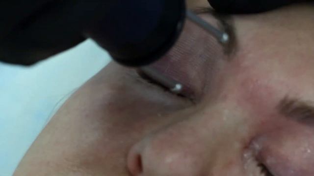 Фракционное лазерное омоложение / Лазерная шлифовка / Эрбиевый лазер Asclepion Dermablate смотреть онлайн