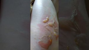 Ожог ноги кипятком (2 день)