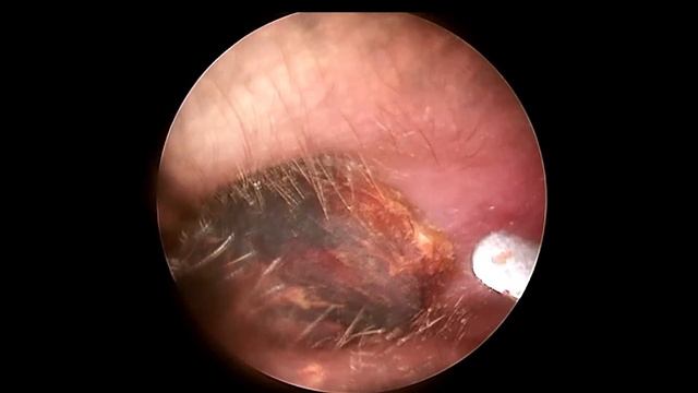 BIGGEST Ear Wax, Difficult Removal - EP2 | Doctor Anh смотреть онлайн