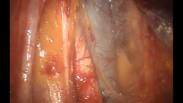 Robotic-Assisted Laparoscopic Pelvic Lymph Node Dissection смотреть онлайн