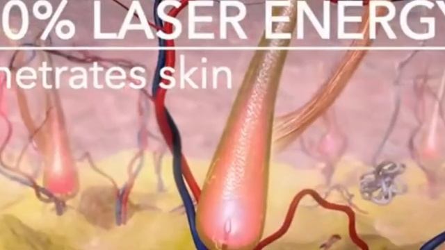 Лазерная эпиляция на александритовом лазере Deka Motus AX. смотреть онлайн