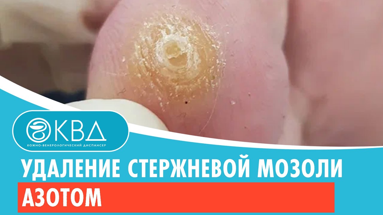 ? Удаление стержневой мозоли азотом. Клинический случай №392 смотреть онлайн