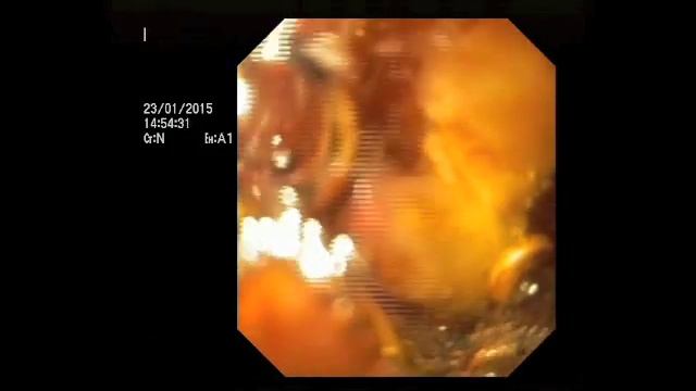 Cholangioscopy trans-SEMS with slim pediatric scope Olympus смотреть онлайн