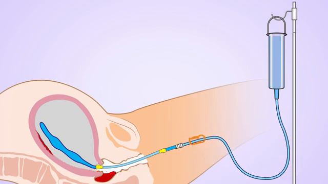 Free Flow Zhukovskiy Balloon Tamponade Animation for vaginal delivery смотреть онлайн