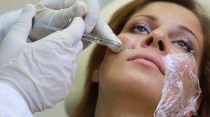 Контурная пластика носогубных складок и контура губ