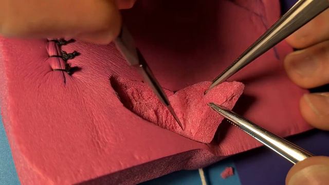 Basic Rotational Flap 3/5 : Undermining and Mobilizing the Flap смотреть онлайн