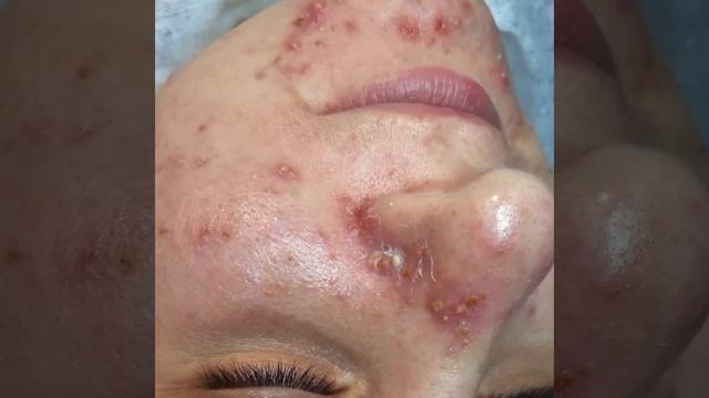 Акне - Угревая болезнь 4 степень смотреть онлайн