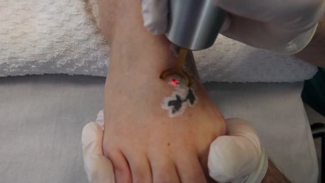 PicoWay Tattoo Removal