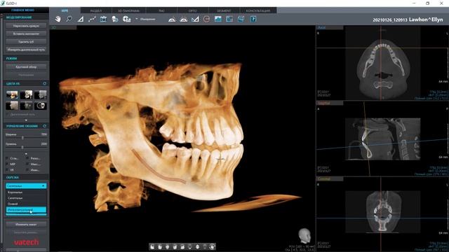 Визуализация КЛКТ данных, полученный на аппарате Green 16, в программе Ez3D-i Advanced смотреть онлайн