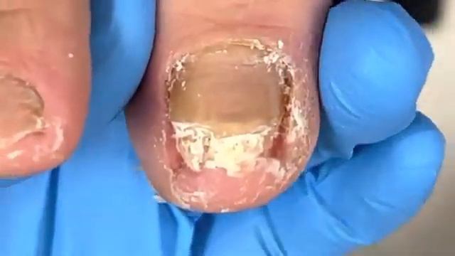 Very Thick Toenails, Hard And Dry【Xue Yidao Pedicure】
