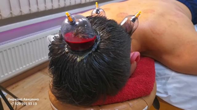 Как делать Хиджаму на голову? | Хиджама Авиценна