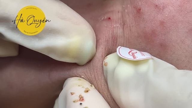 |585| The girl's blackheads were treated after 6 months 29/10/2023 ep1 смотреть онлайн