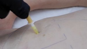 Карбокситерапия | Аппарат МедЭксперт СО2 | Обучение