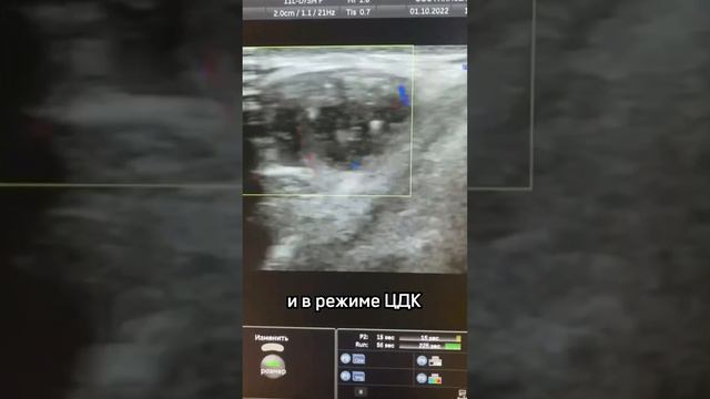 Обнаружили срединную кисту шеи. Грамотный высококвалифицированный УЗИ-врач Эльвира Муртазалиевна🌹 смотреть онлайн