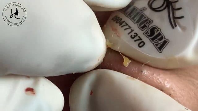 Huong Da Nang Acne Treatment #351