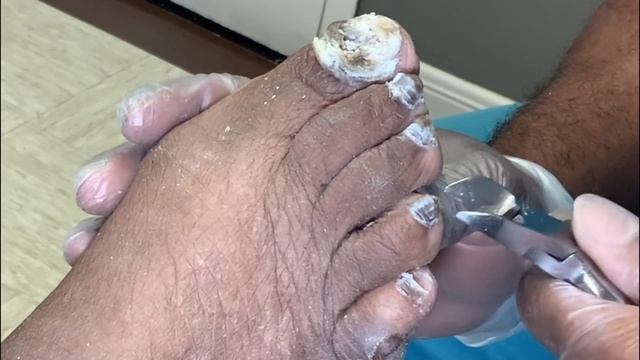 Fungal Nail Destruction, Part 2: Making Progress! Toenail Fungus Under Nail Polish