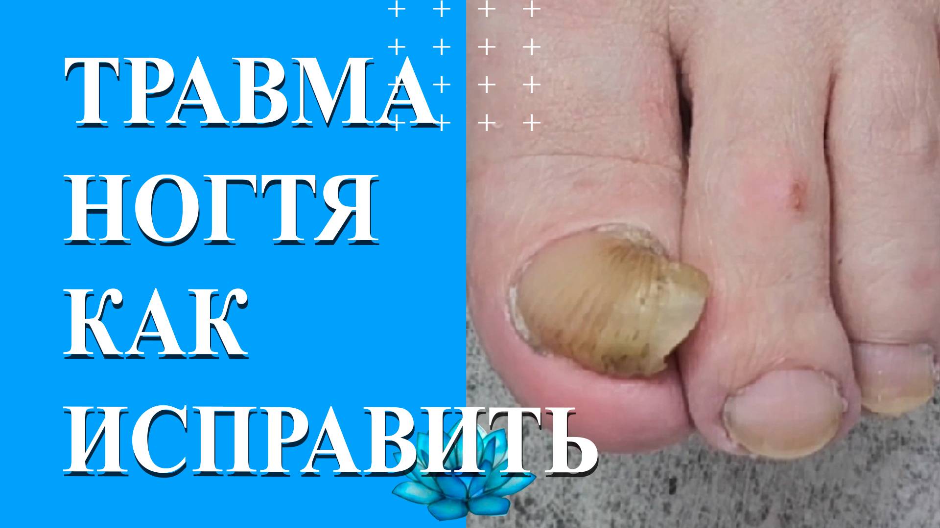 У клиента сильный ушиб ногтя. Делаем аппаратный педикюр. смотреть онлайн