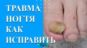 У клиента сильный ушиб ногтя. Делаем аппаратный педикюр.