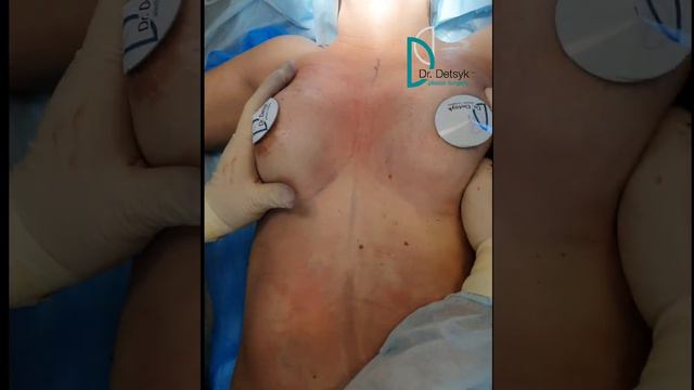 Липофилинг груди. Может ли быть альтернатива увеличению груди имплантами.