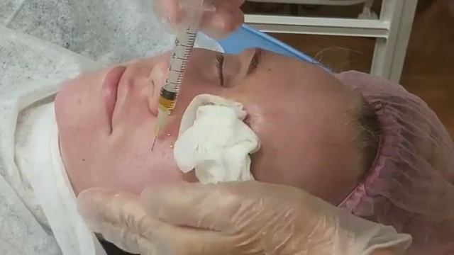 АирисКом студенты учатся: выполнение жёлтого пилинга (ретиноевая кислота) смотреть онлайн