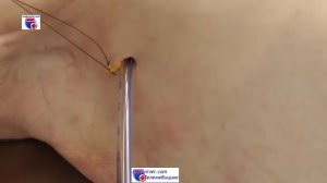 Дренирование плевральной полости (торакоцентез) - meduniver.com