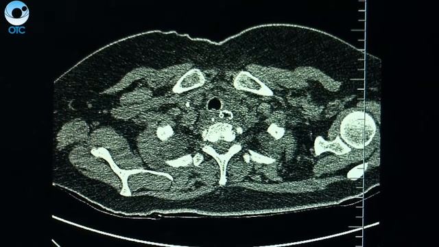 Рубрика "PRO здоровье": торакальный хирург смотреть онлайн