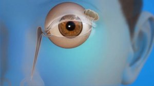 ЗОНДИРОВАНИЕ СЛЕЗНОГО КАНАЛА У ДЕТЕЙ