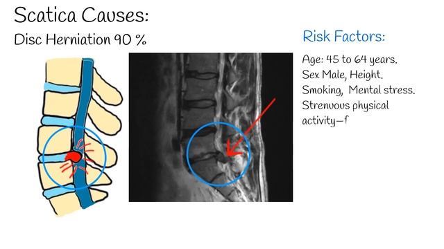 Sciatica - One-sided Leg pain and tingling. Sciatica Symptoms and Treatment. Radiculopathy смотреть онлайн