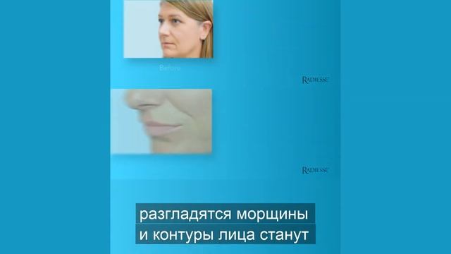 Др. Марина Блюм: Что такое Векторный Лифтинг препаратом Радиесс? смотреть онлайн