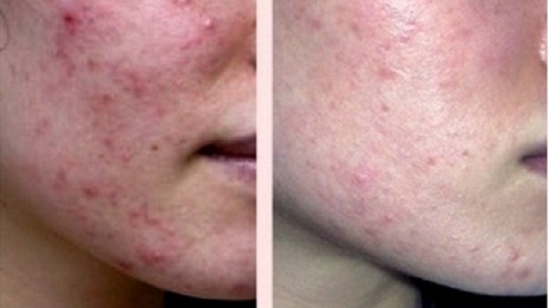 Как Я Избавилась От Прыщей /Акне/Чистая Кожа\\ДЕШЁВЫЕ и ЭФФЕКТИВНЫЕ СРЕДСТВА от ПРЫЩЕЙ смотреть онлайн