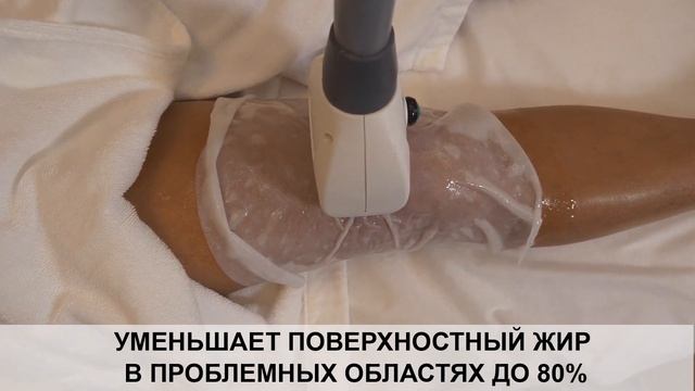 Криолиполиз на аппарате coccon смотреть онлайн