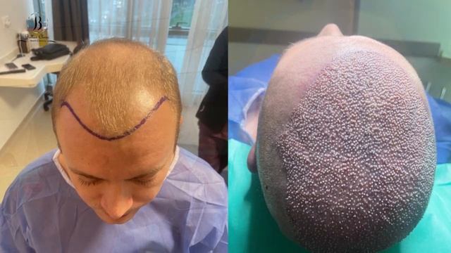 hair transplant in Bellus clinic in istanbul turkey смотреть онлайн