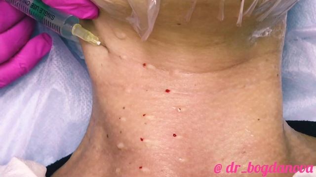 Мезотерапия лица препаратом Dermaheal HSR