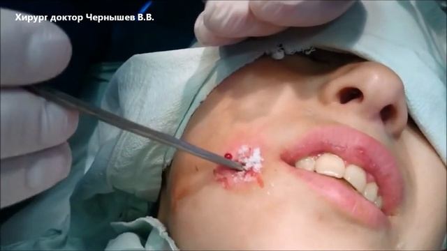 АБСЦЕДИРУЮЩИЙ ФУРУНКУЛ 9 СЕМ смотреть онлайн