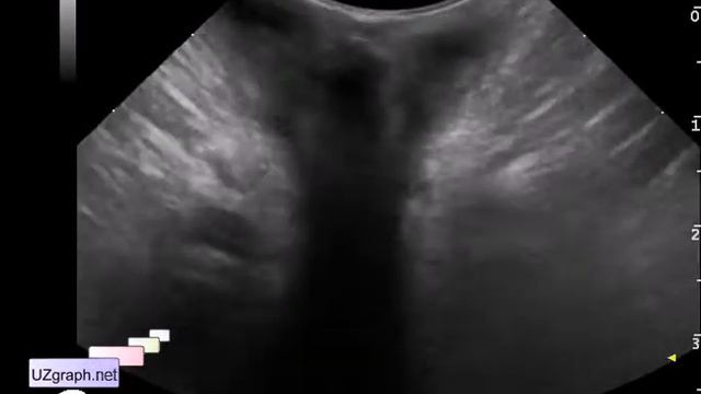 Pediatric Soft tissue ultrasound - bilateral paraproctitis смотреть онлайн