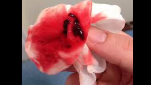 ನೀವು ಎಷ್ಟು ಆರೋಗ್ಯವಾಗಿದ್ದಿರ ಎಂದು ನಿಮ್ಮ ಪಿರೇಡ್ಸ್ ಬ್ಲಡ್ ಕಲರ್ ತಿಳಿಸತ್ತೆ| Period Blood Color Your Health смотреть онлайн