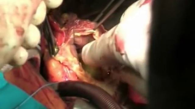 Surgical Implantation of CardioWest™ Total Artificial Heart смотреть онлайн