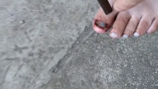 Николай Иванович. Вырвал ноготь плоскогубцами. смотреть онлайн