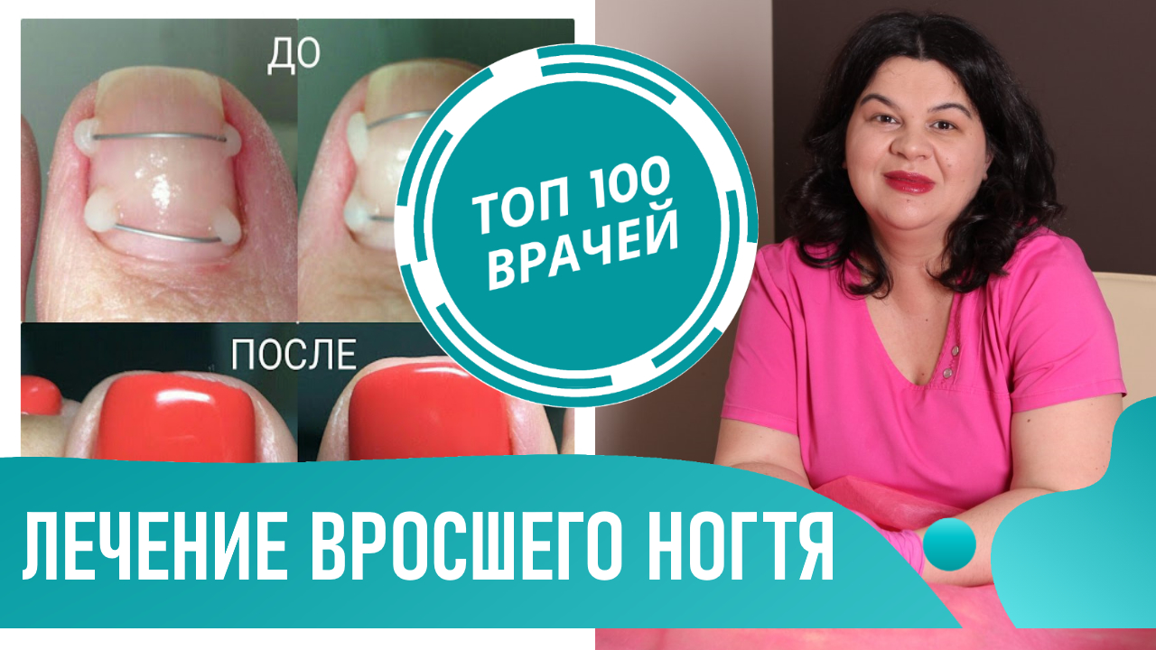 Как лечить Вросший Ноготь на ноге. Лечение и удаление вросшего ногтя на большом пальце ноги смотреть онлайн