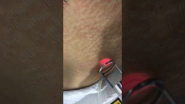 Лазерная СО2 шлифовка растяжек смотреть онлайн
